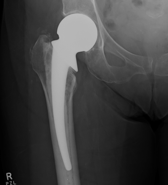 Thompsons Hemiarthroplasty